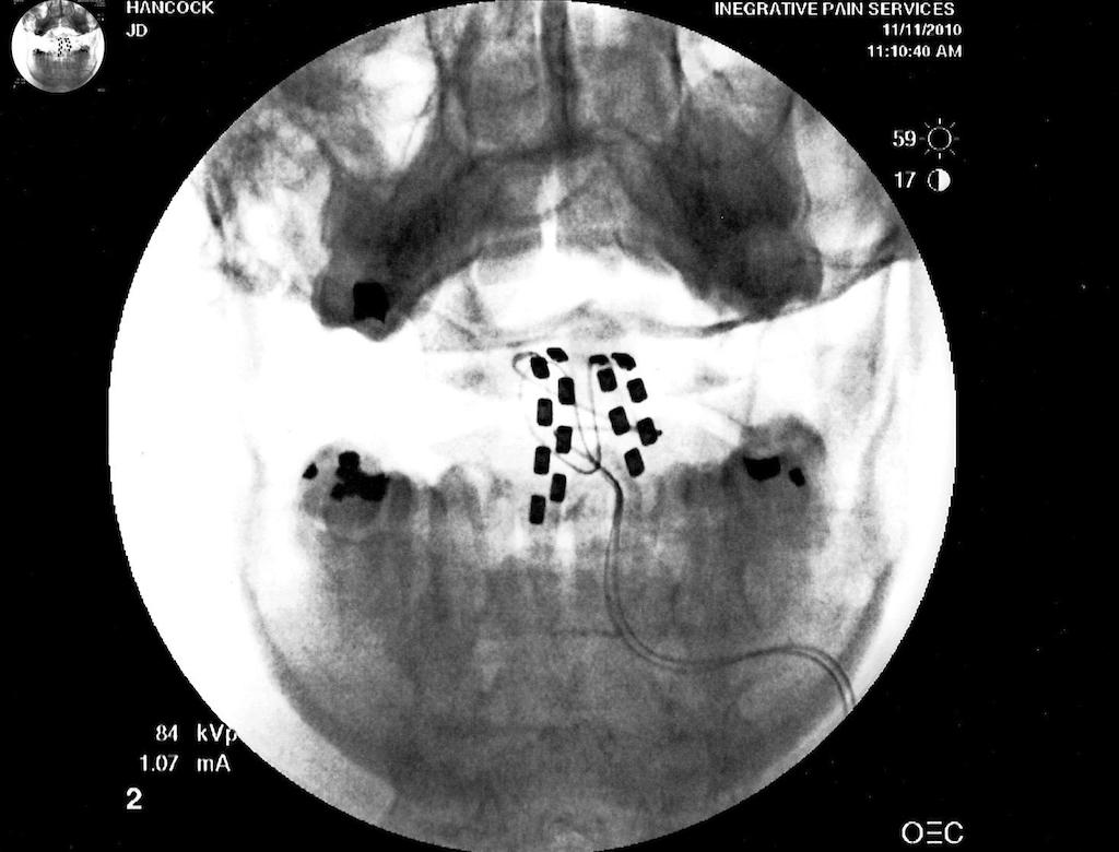 X-ray of my cyborg implants, November 11, 2010