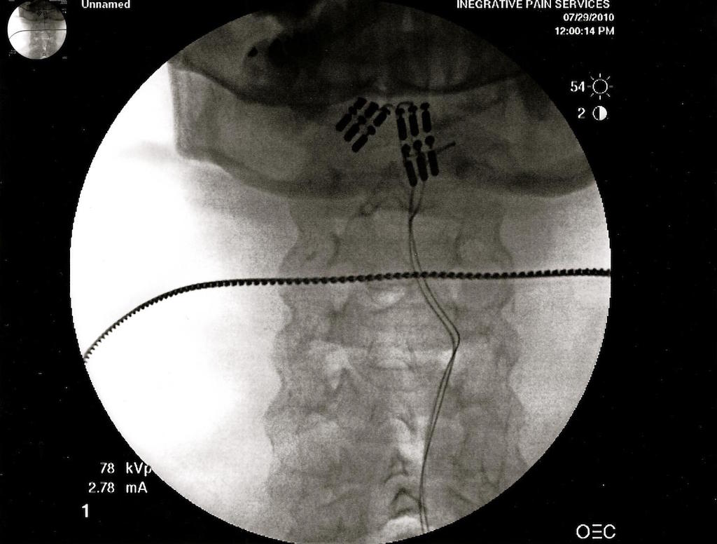 X-ray of my cyborg implants, July 29, 2010